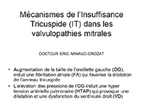 Mécanismes de l’IT dans les valvuloplasties mitrales